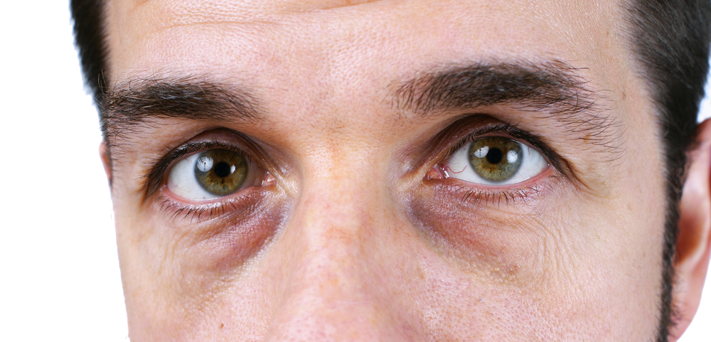 Man with dark circles under his eyes