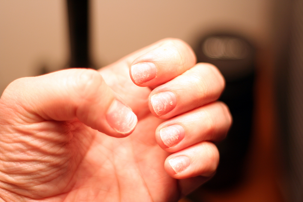 Brittle Damaged Nails