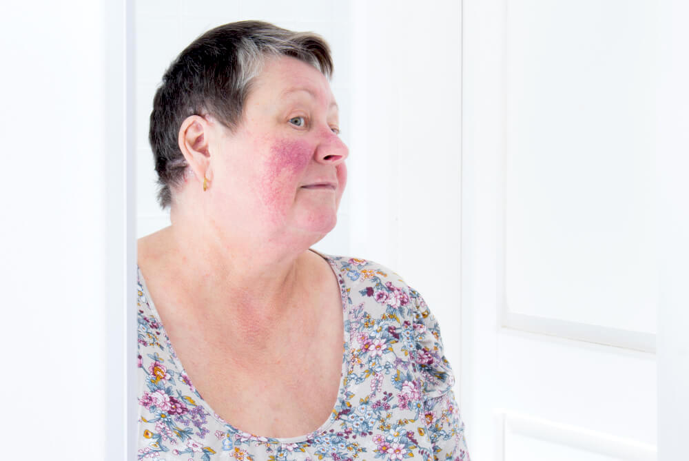 woman with rosacea looking in the mirror