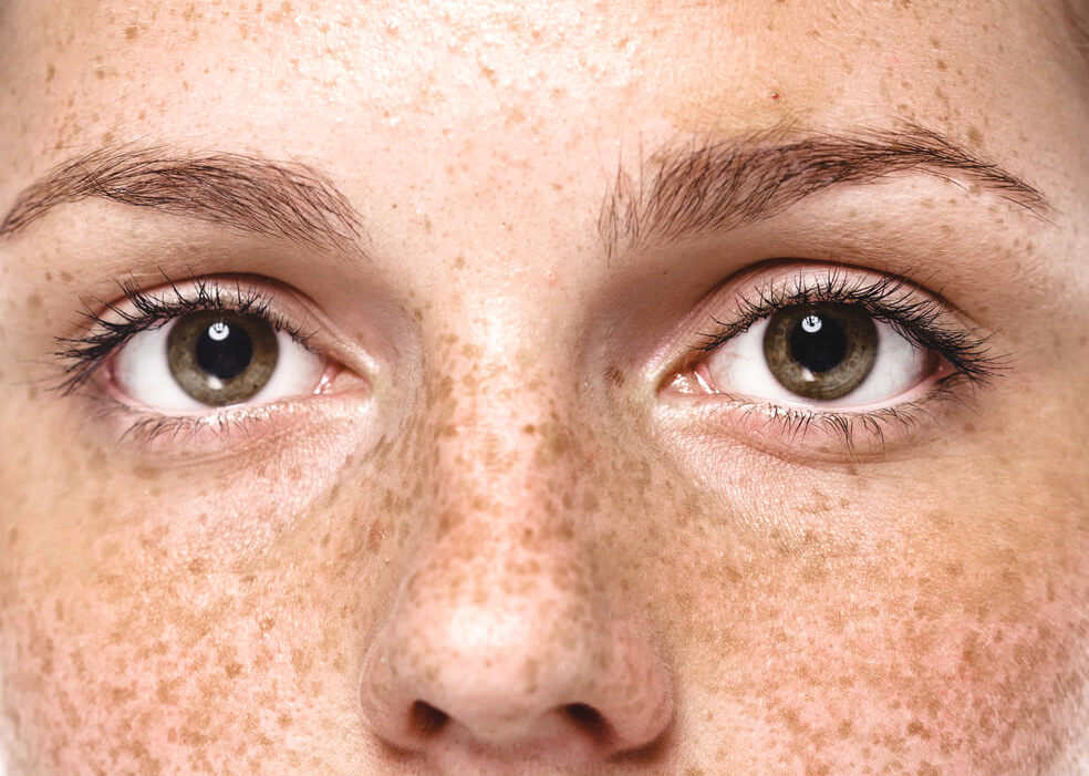 Closeup of freckles and dark spots on woman's face