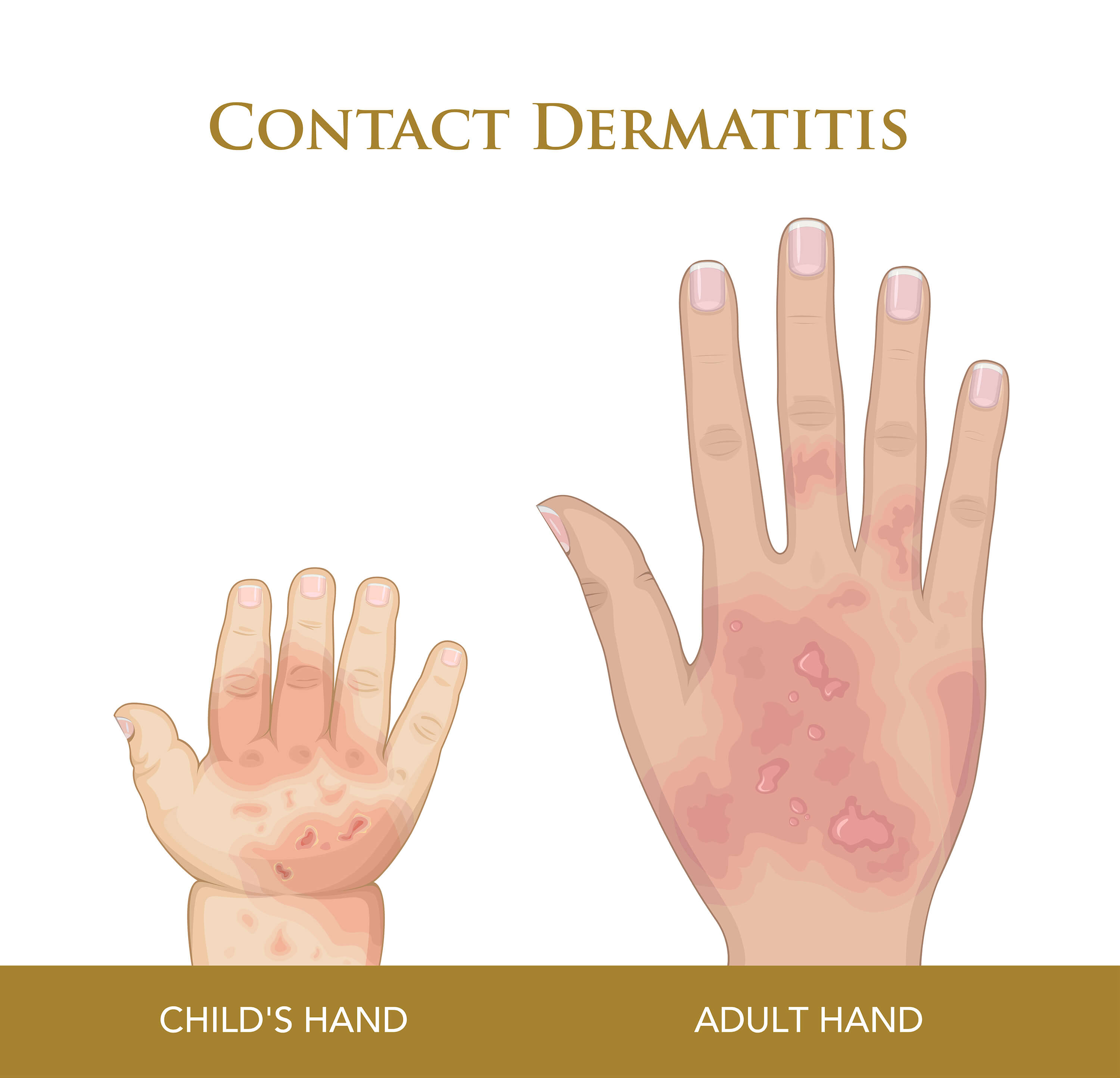 Know The Difference Between Allergic And Irritant Dermatitis Oro Gold