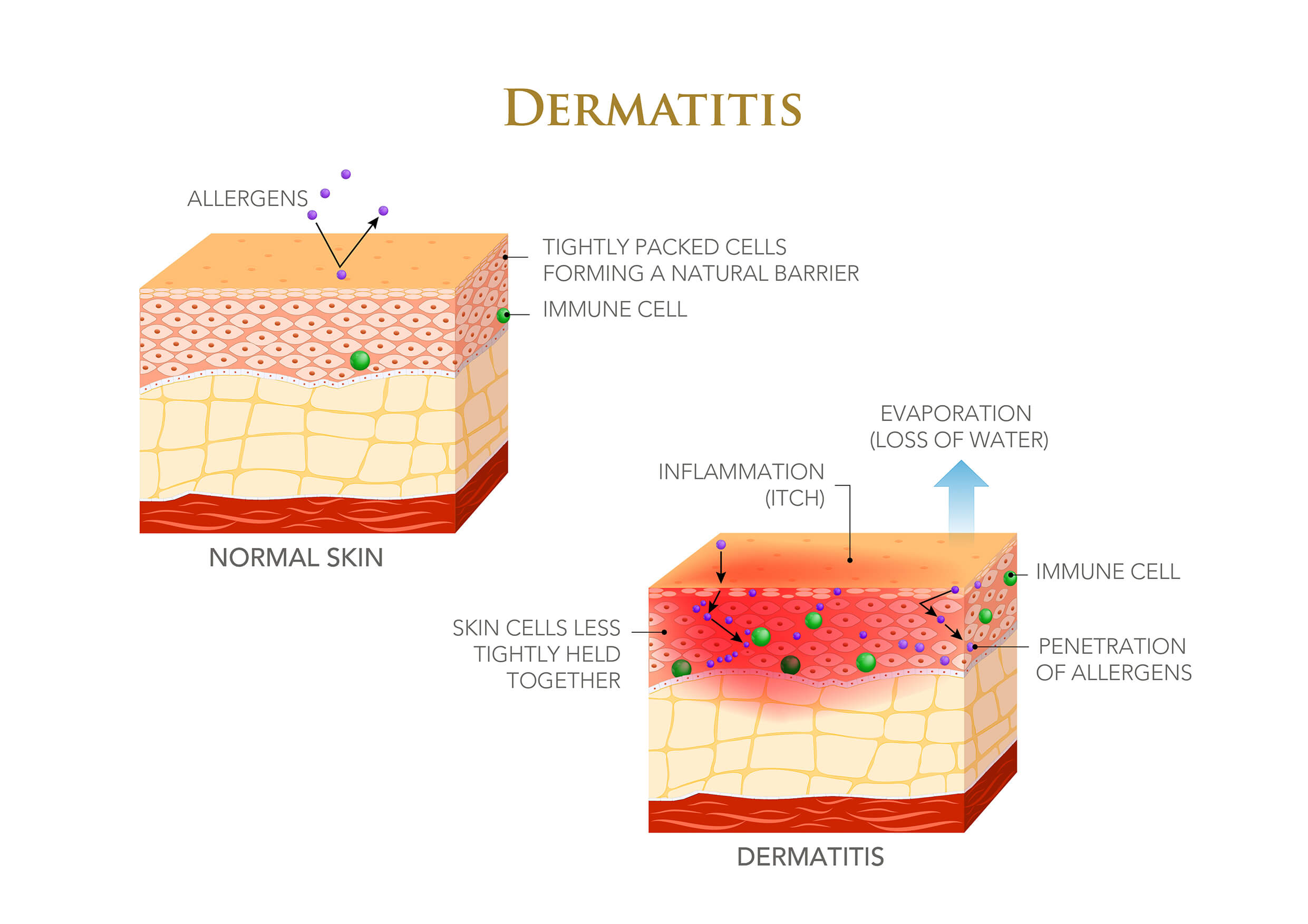 Irritant VS. Allergic Contact Dermatitis: What's the Difference