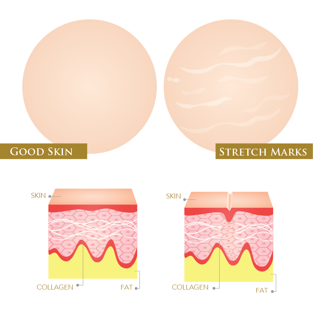 How to Deal with Stretch Marks and Loose Skin ORO GOLD School