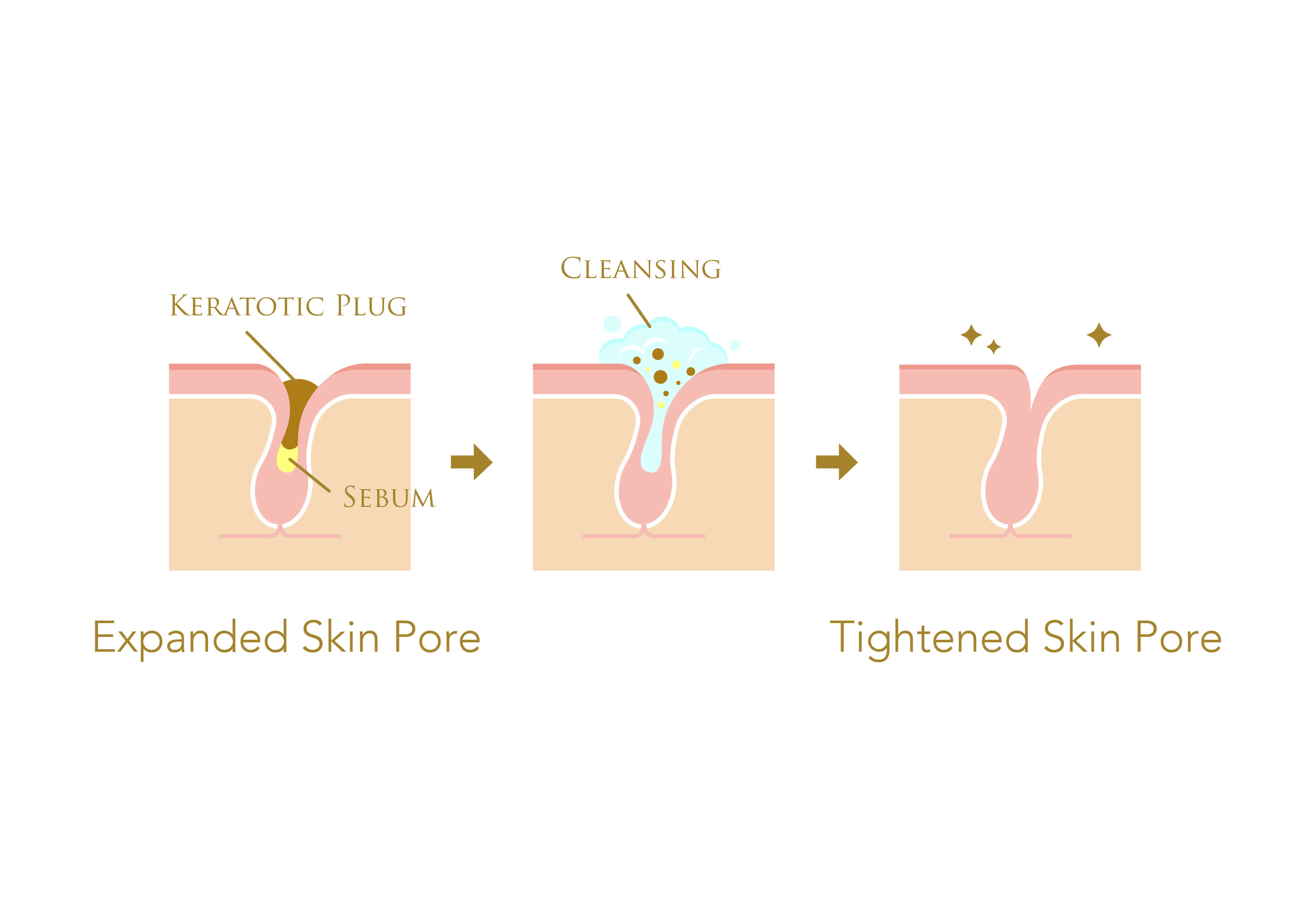Infographic on how cleansing removes clogged pores