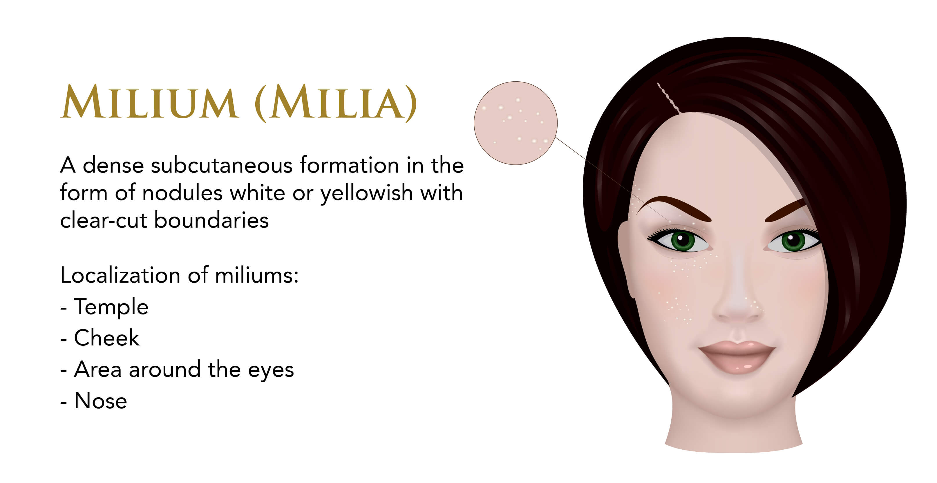 Infographic on milia on the skin