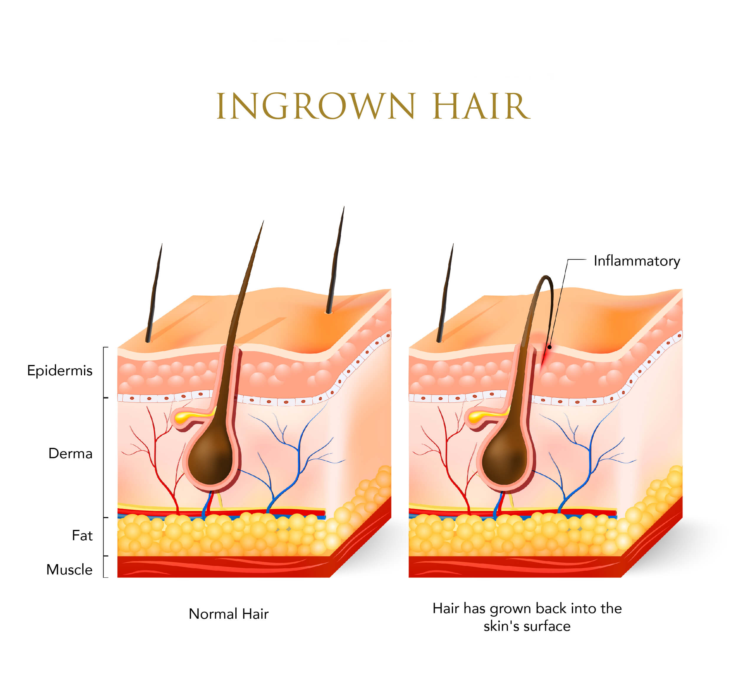 Infographic showing a normal hair and an ingrown hair